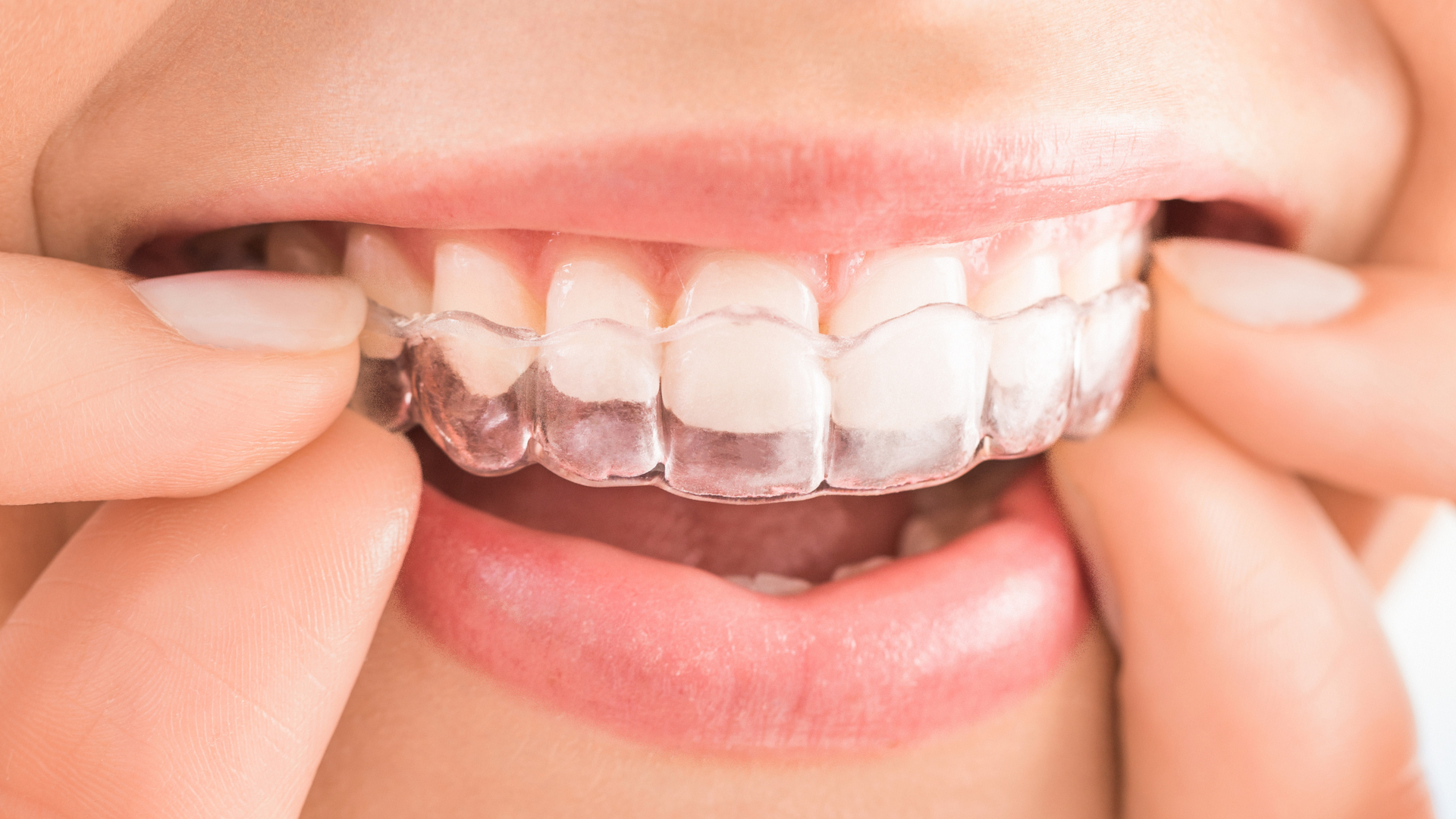 Invisalign