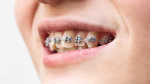 Invisalign Petrolina