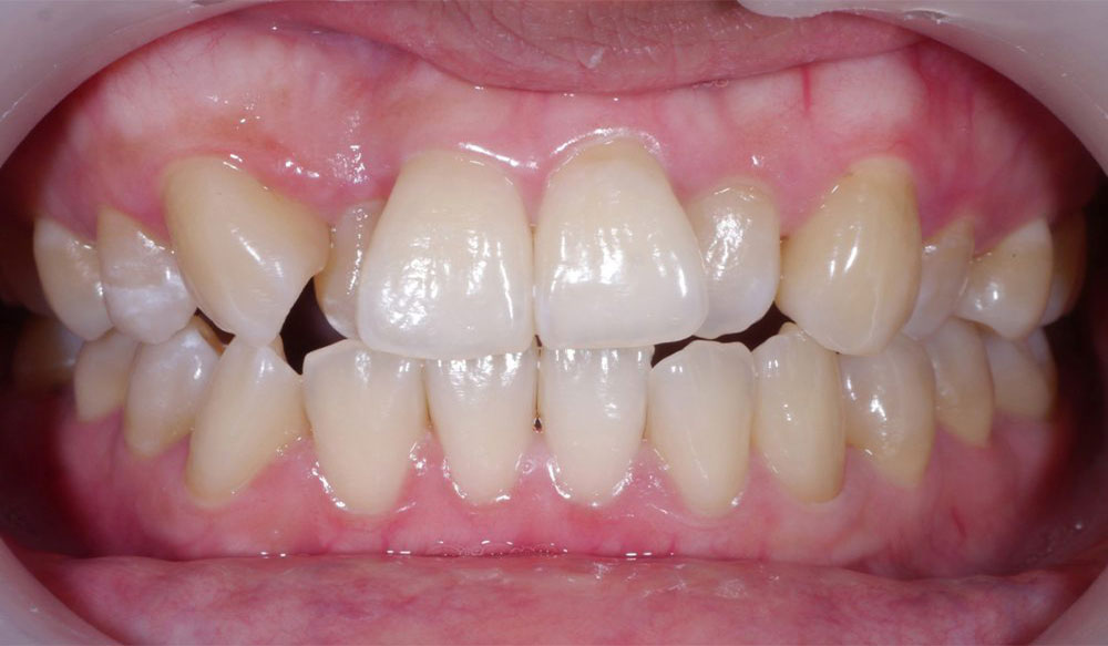 invisalign-aparelho-invisivel Aparelho invisível