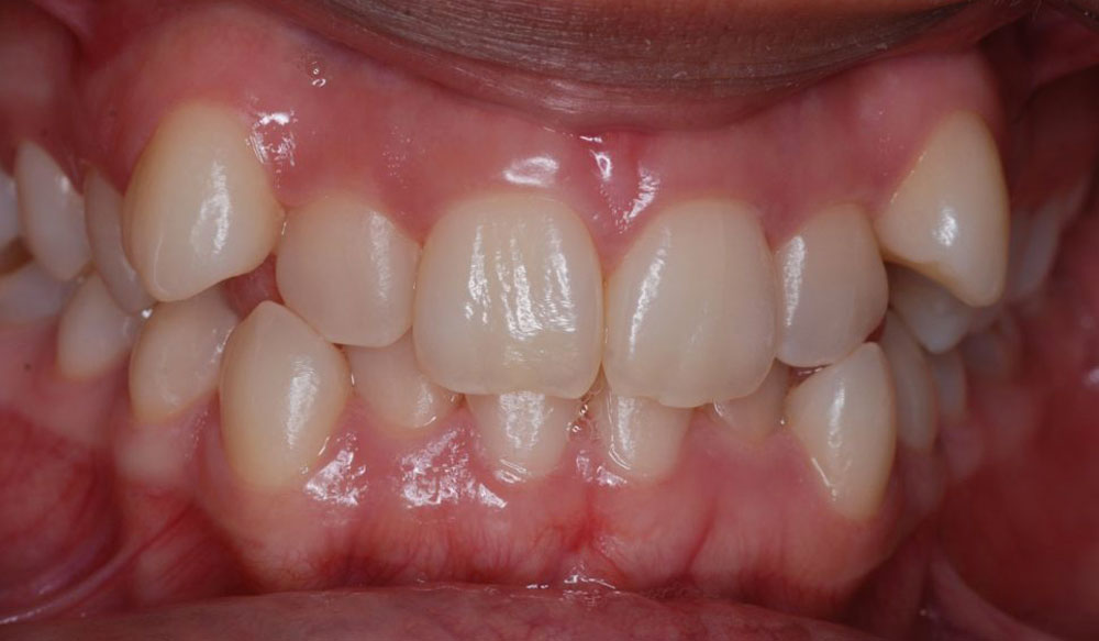 invisalign-aparelho-invisivel Aparelho invisível