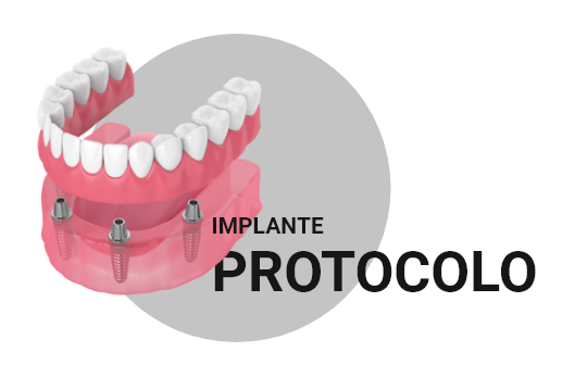 Implantes Dentários em Petrolina