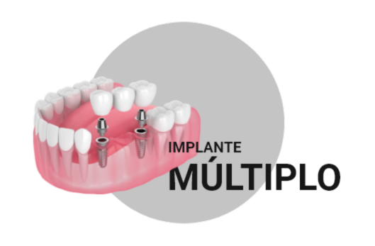 Implantes Dentários em Petrolina