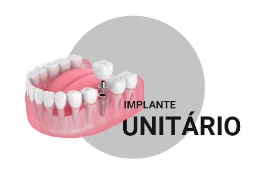 Implantes Dentários em Petrolina
