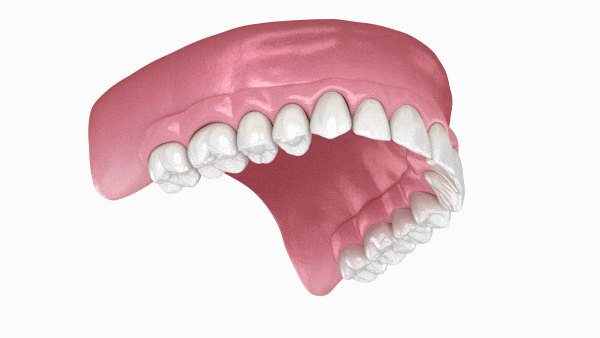 Implante dentário