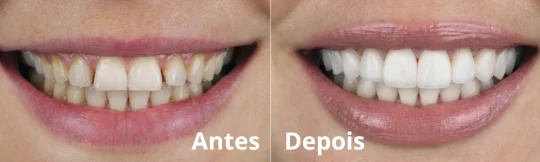 Lentes de Contato