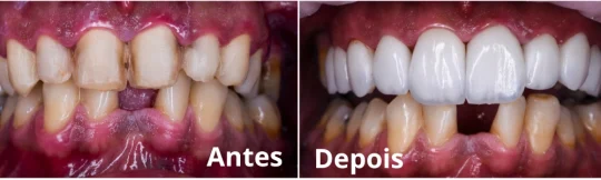 Facetas de Resina