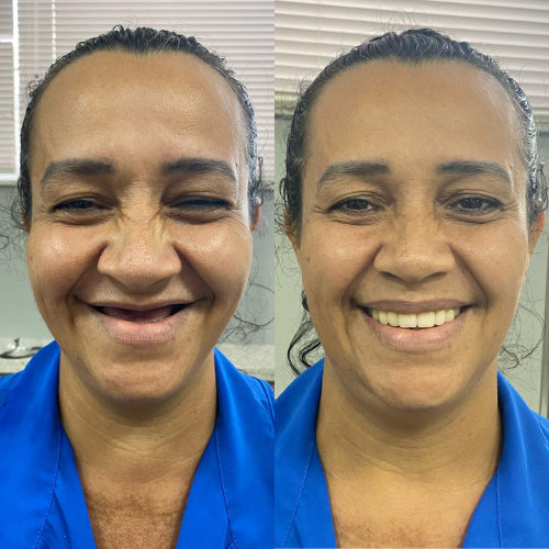 Antes e Depois
